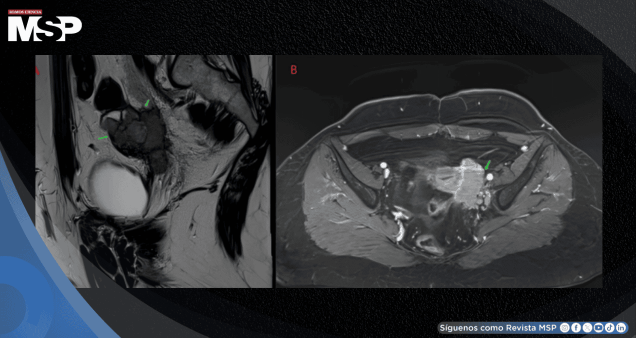 Mujer con dismenorrea y masa anexial fue diagnosticada con carcinoma folicular en estroma ovárico Mujer con dismenorrea y masa anexial fue diagnosticada con carcinoma folicular en estroma ovárico