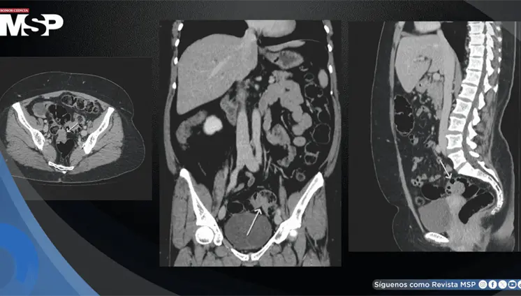 Endometriosis intestinal infiltrativa simul&oacute; c&aacute;ncer colorrectal al producir sangrado rectal y estenosis 
