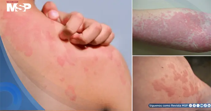 Nuevas opciones para la urticaria crónica espontánea: reduciría ronchas y picazón en 12 semanas Nuevas opciones para la urticaria crónica espontánea: reduciría ronchas y picazón en 12 semanas