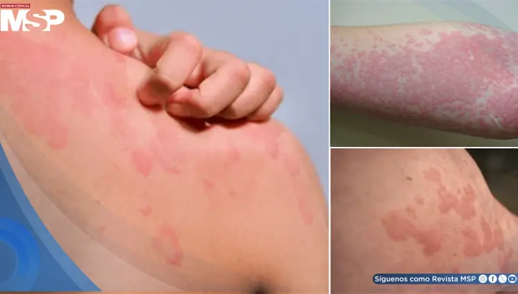 Nuevas opciones para la urticaria crónica espontánea: reduciría ronchas y picazón en 12 semanas Nuevas opciones para la urticaria crónica espontánea: reduciría ronchas y picazón en 12 semanas