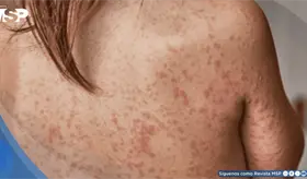 &iquest;Qu&eacute; es el sarampi&oacute;n? C&oacute;mo se contagia, s&iacute;ntomas, riesgos y c&oacute;mo prevenir esta enfermedad contagiosa