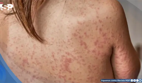 &iquest;Qu&eacute; es el sarampi&oacute;n? C&oacute;mo se contagia, s&iacute;ntomas, riesgos y c&oacute;mo prevenir esta enfermedad contagiosa