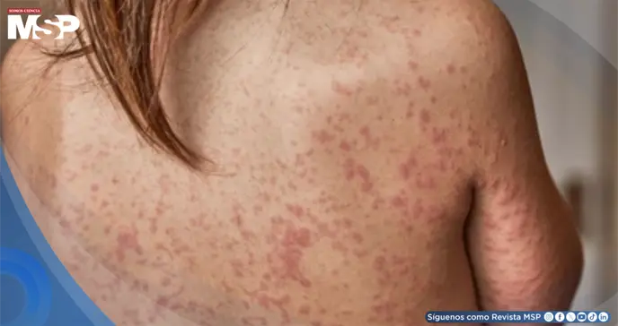 ¿Qué es el sarampión? Cómo se contagia, síntomas, riesgos y cómo prevenir esta enfermedad contagiosa ¿Qué es el sarampión? Cómo se contagia, síntomas, riesgos y cómo prevenir esta enfermedad contagiosa