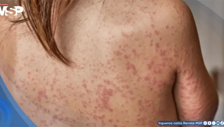 ¿Qué es el sarampión? Cómo se contagia, síntomas, riesgos y cómo prevenir esta enfermedad contagiosa ¿Qué es el sarampión? Cómo se contagia, síntomas, riesgos y cómo prevenir esta enfermedad contagiosa