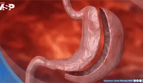 Cirug&iacute;a bari&aacute;trica supera a f&aacute;rmacos GLP-1 en protecci&oacute;n cardiovascular de pacientes con diabetes tipo 2