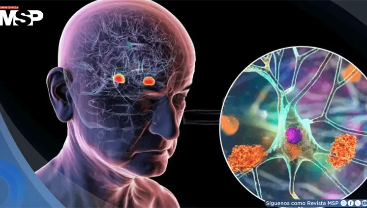 Un análisis de sangre podría predecir el alzhéimer hasta 20 años antes de que aparezcan los síntomas Un análisis de sangre podría predecir el alzhéimer hasta 20 años antes de que aparezcan los síntomas