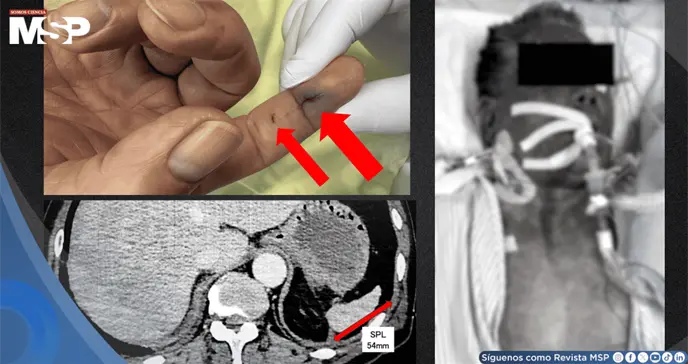Sepsis tras mordedura de perro en hombre hipertenso con infección por Capnocytophaga y atrofia esplénica