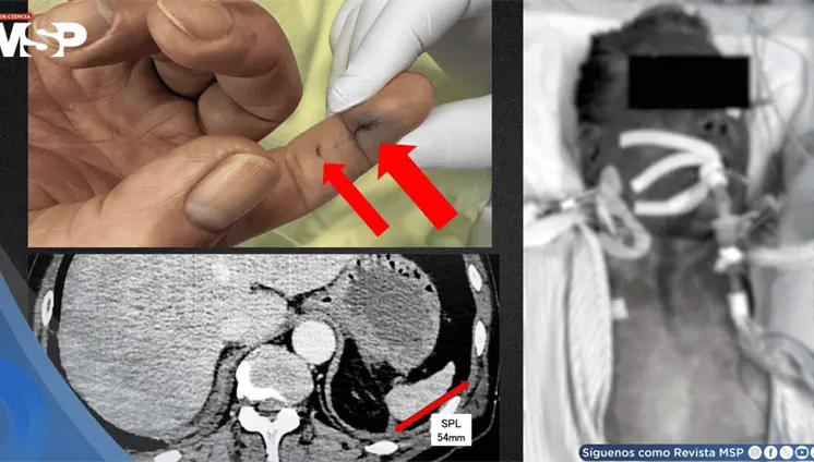 Sepsis tras mordedura de perro en hombre hipertenso con infecci&oacute;n por Capnocytophaga y atrofia espl&eacute;nica