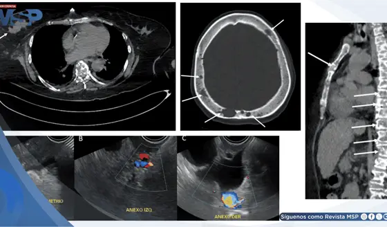Pancreatitis aguda como presentaci&oacute;n inicial de c&aacute;ncer de mama metast&aacute;sico debido a hipercalcemia maligna