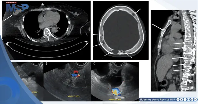 Pancreatitis aguda como presentaci&oacute;n inicial de c&aacute;ncer de mama metast&aacute;sico debido a hipercalcemia maligna