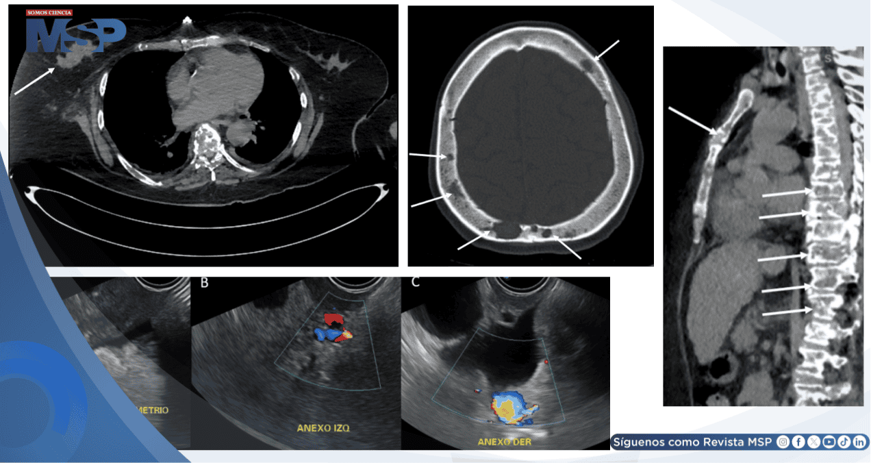 Pancreatitis aguda como presentación inicial de cáncer de mama metastásico debido a hipercalcemia maligna Pancreatitis aguda como presentación inicial de cáncer de mama metastásico debido a hipercalcemia maligna