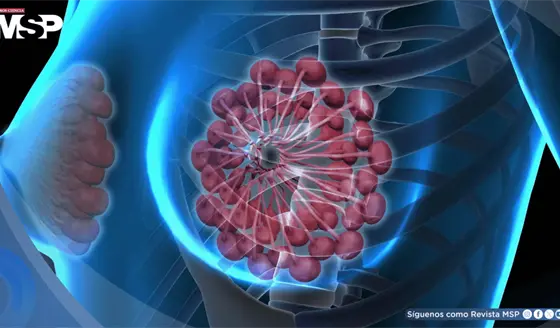 C&aacute;ncer de mama crecer&aacute; 34% en el 2050 y podr&iacute;a causar 1,4 millones de muertes al a&ntilde;o: Estudio