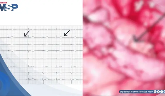 Bradicardia sinusal persistente con inestabilidad hemodin&aacute;mica tras apendicectom&iacute;a laparosc&oacute;pica en menor