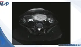 Apendicitis aguda enmascarada por hiperemesis grav&iacute;dica:Dolor lumbar intratable en gestante de 14 semanas