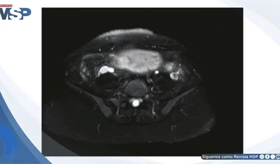 Apendicitis aguda enmascarada por hiperemesis gravídica:Dolor lumbar intratable en gestante de 14 semanas