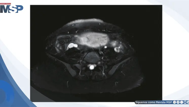 Apendicitis aguda enmascarada por hiperemesis grav&iacute;dica:Dolor lumbar intratable en gestante de 14 semanas