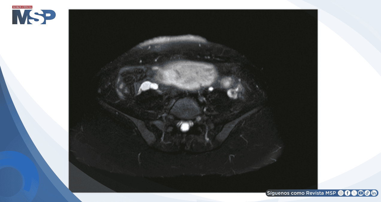Apendicitis aguda enmascarada por hiperemesis gravídica:Dolor lumbar intratable en gestante de 14 semanas Apendicitis aguda enmascarada por hiperemesis gravídica:Dolor lumbar intratable en gestante de 14 semanas