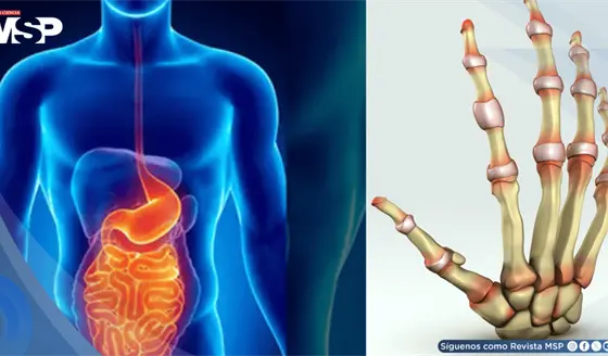 Dolor articular, diarrea y sangre en heces: As&iacute; se manifiesta la artritis asociada a Crohn y Colitis