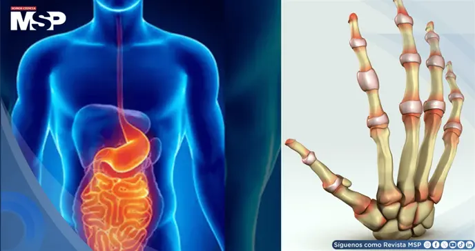 Dolor articular, diarrea y sangre en heces: As&iacute; se manifiesta la artritis asociada a Crohn y Colitis