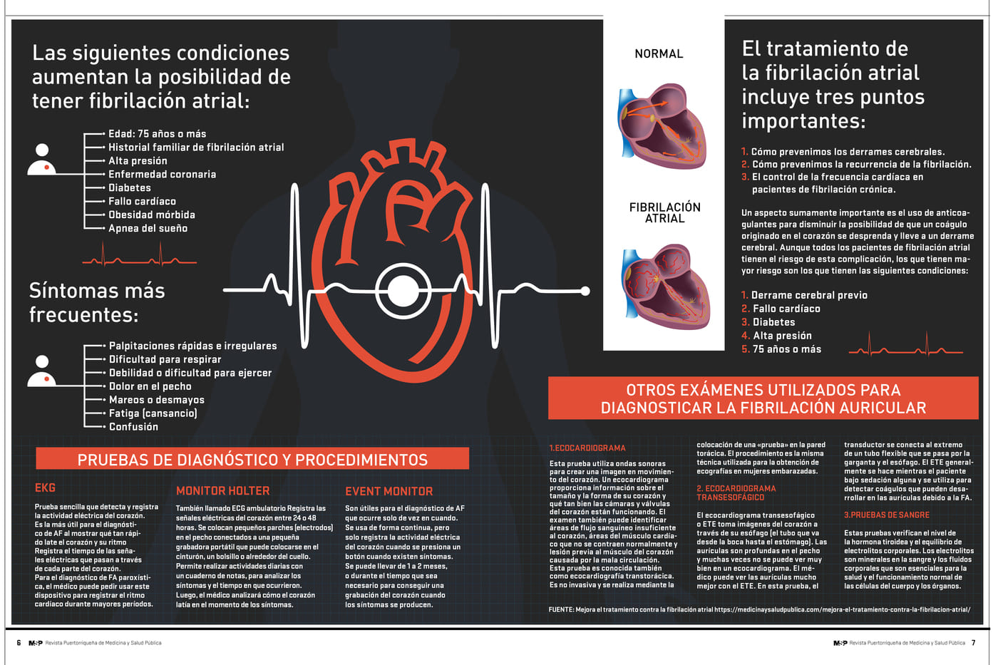 Infografía sobre Fibrilación Atrial